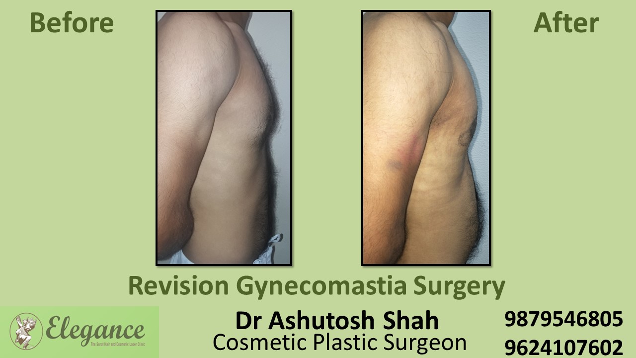 Revision Gynecomastia Surgery in Daman, Gujarat, India.