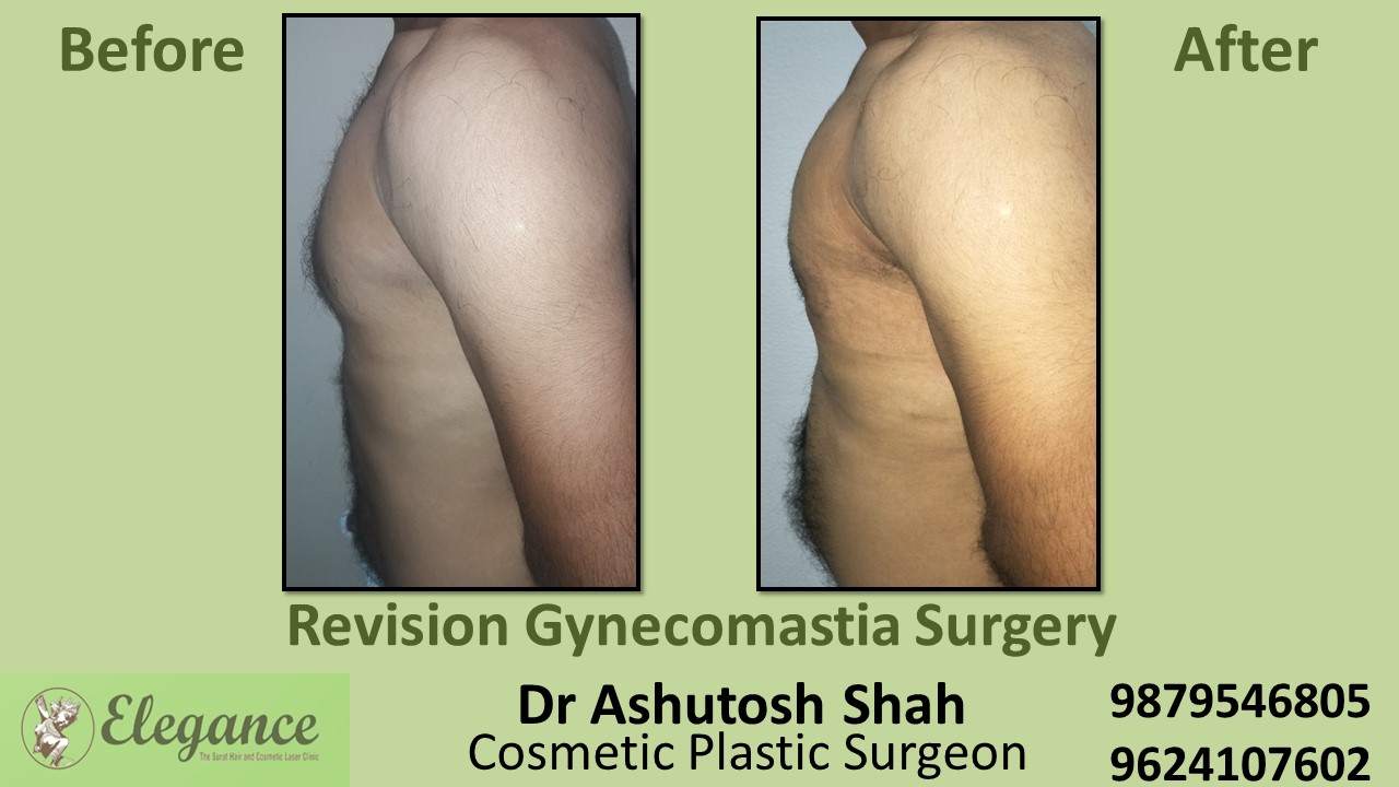Revision Gynecomastia Surgery in Navsari, Gujarat, India.