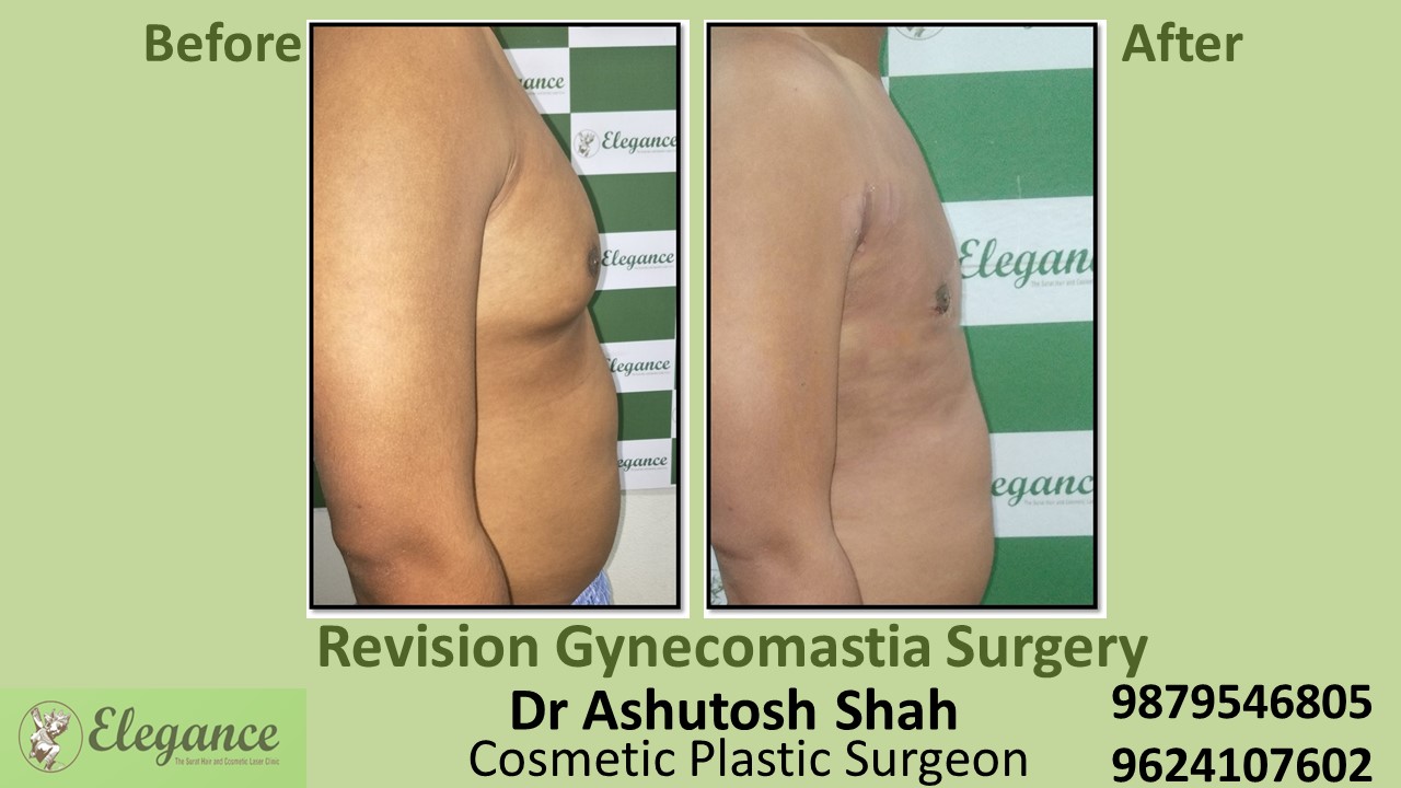 Revision Gynecomastia Surgery in Surat, Gujarat.