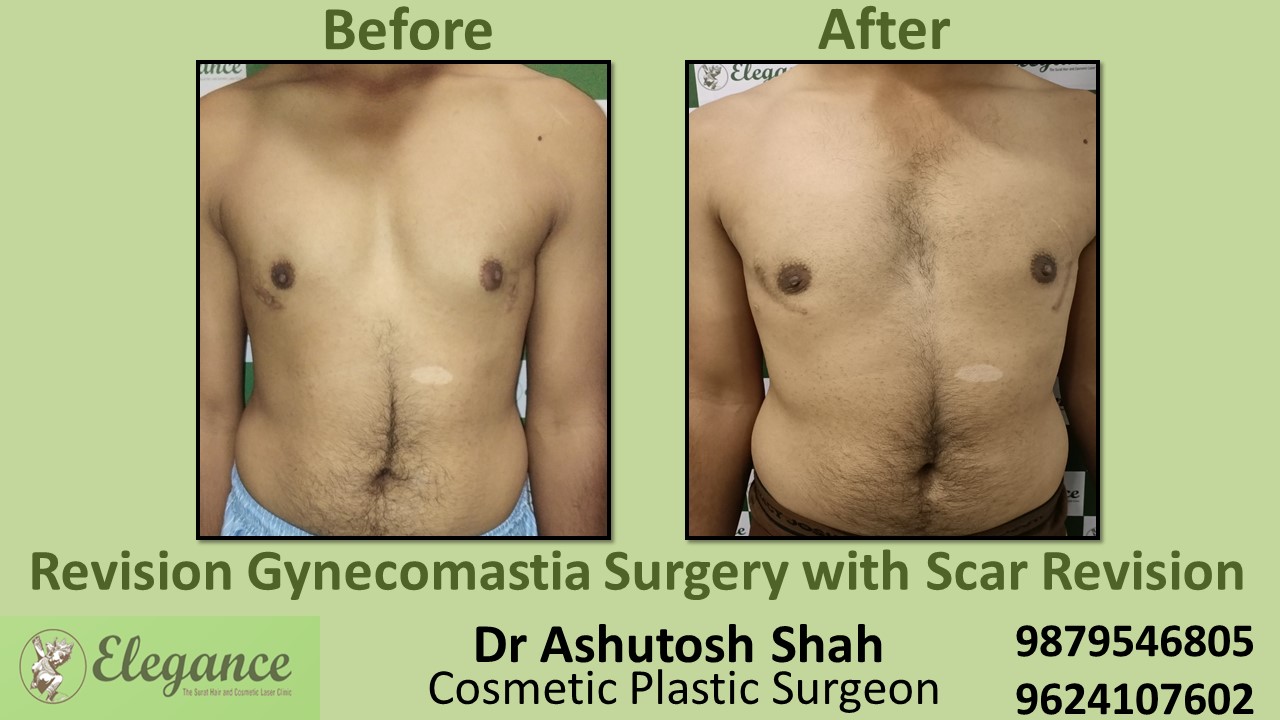 Revision Gynecomastia Surgery, Mangrol, Gujarat, India.