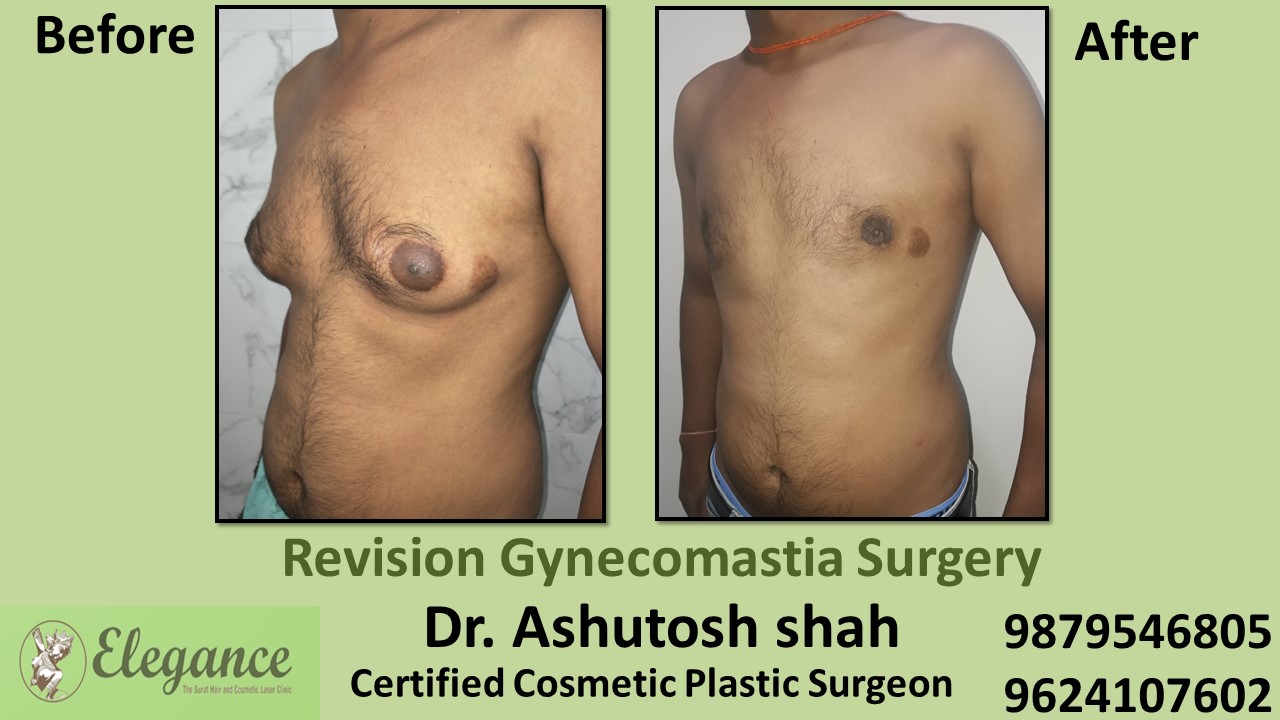 Revision Gynecomastia Surgery, Selvasa, Gujarat, India.