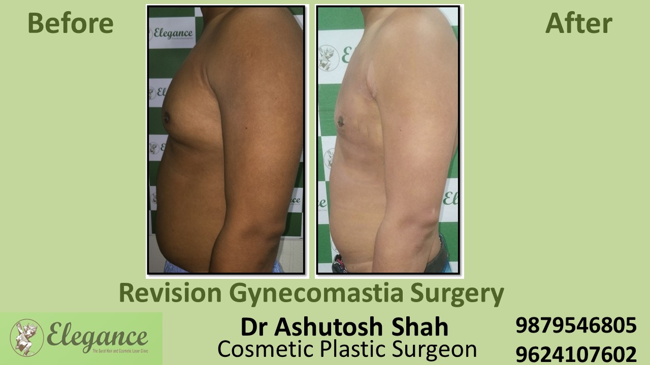 Revision Gynecomastia Treatment in Bardoli, Gujarat.