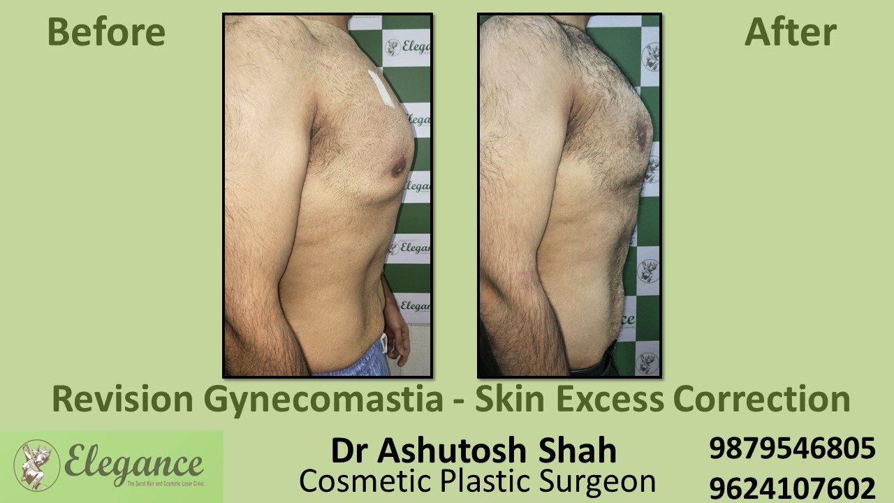 Revision Gynecomastia Treatment Vadodara, Gujarat, India.
