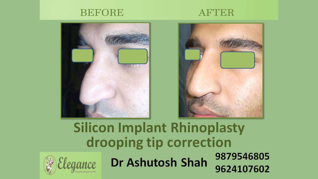 Silicone Implant For Nose
