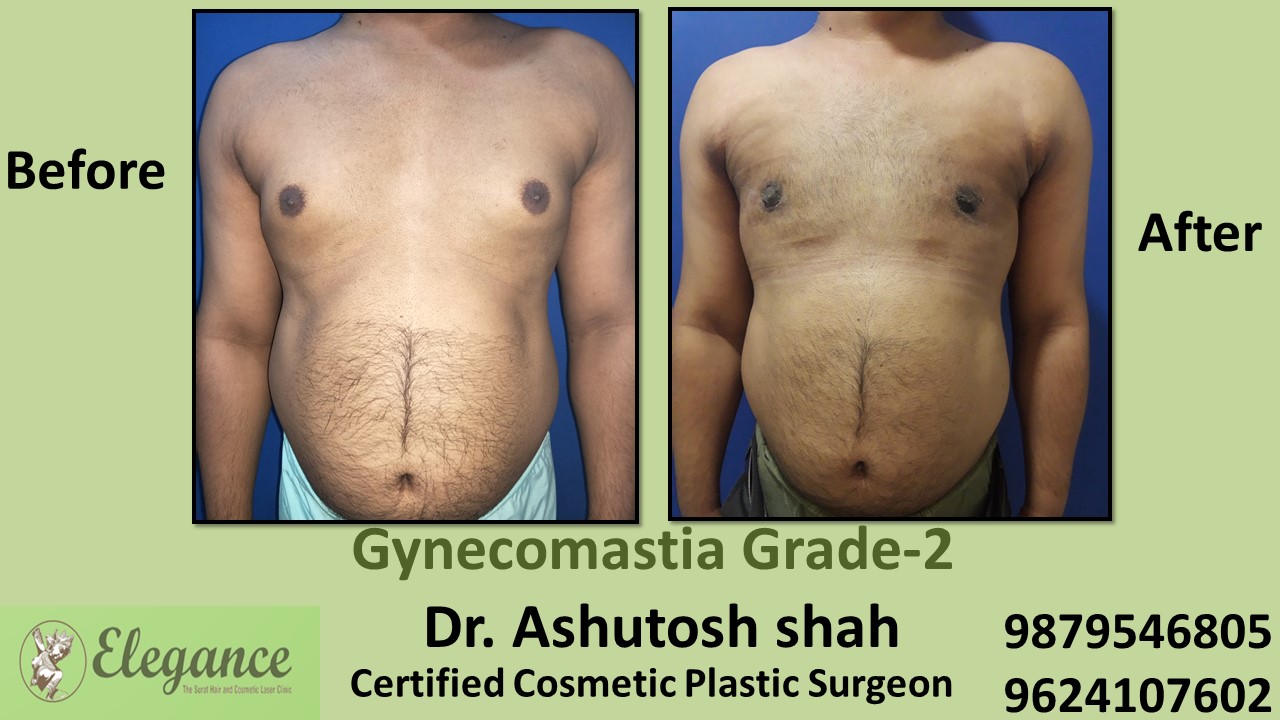 Round Boobs in Male, Gynecomastia Grade-2, Ankleshwar, Gujarat, India.