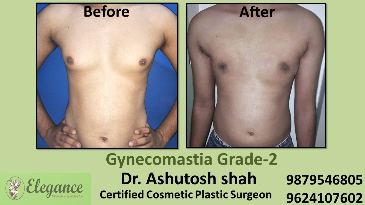 Round Boobs in Male, Gynecomastia Grade-2, Surat, Gujarat, India.