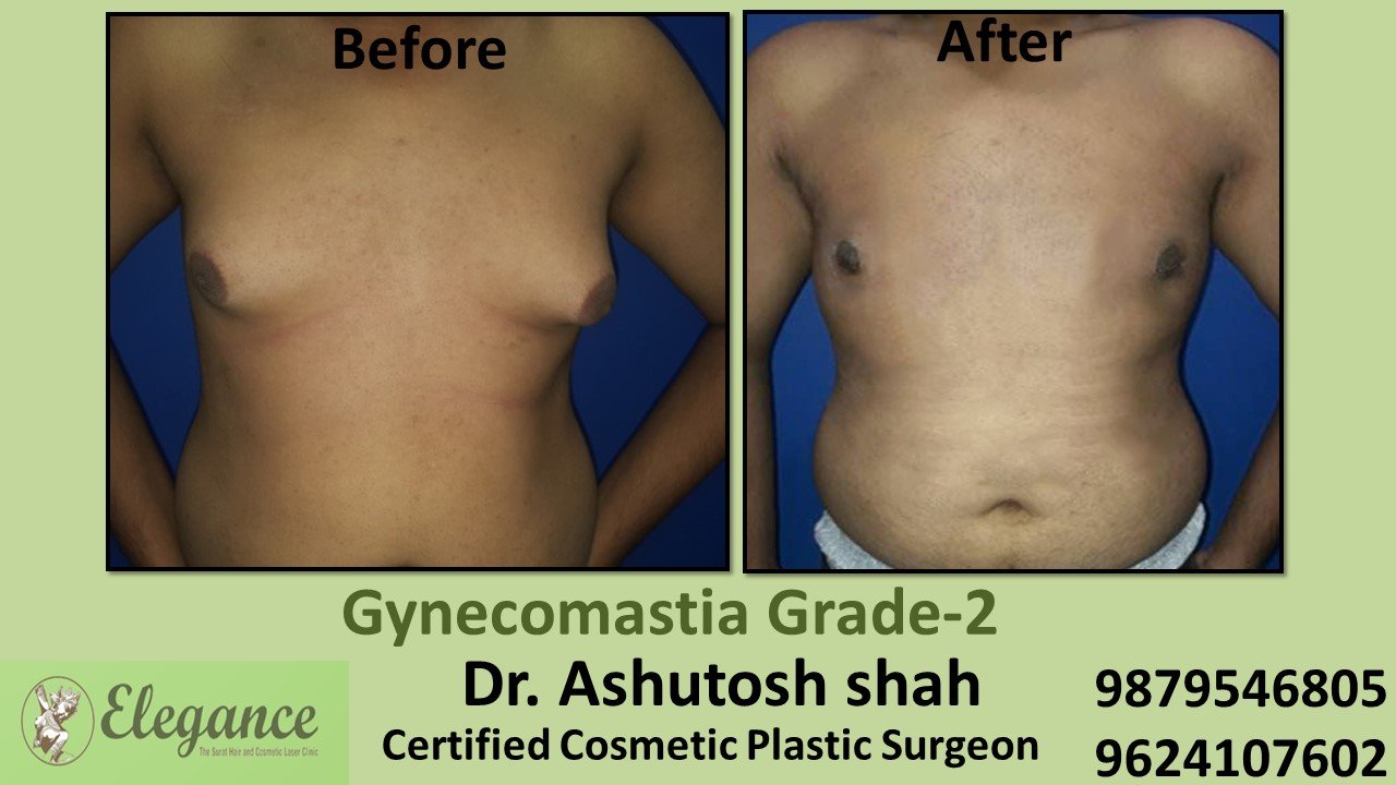 Round Boobs in Male, Gynecomastia Grade-2, Surat, Gujarat, India.