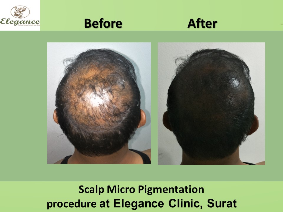 Scalp micro-pigmentation Treatment, Surat, Gujarat, India.