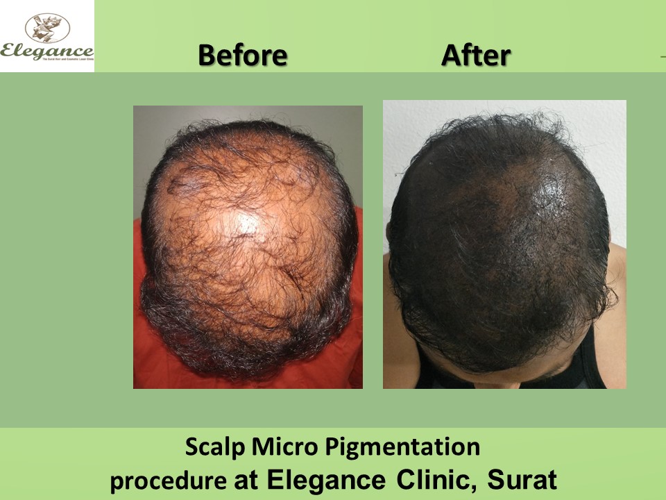 Scalp micro-pigmentation Treatment, Vadodara, Gujarat, India.