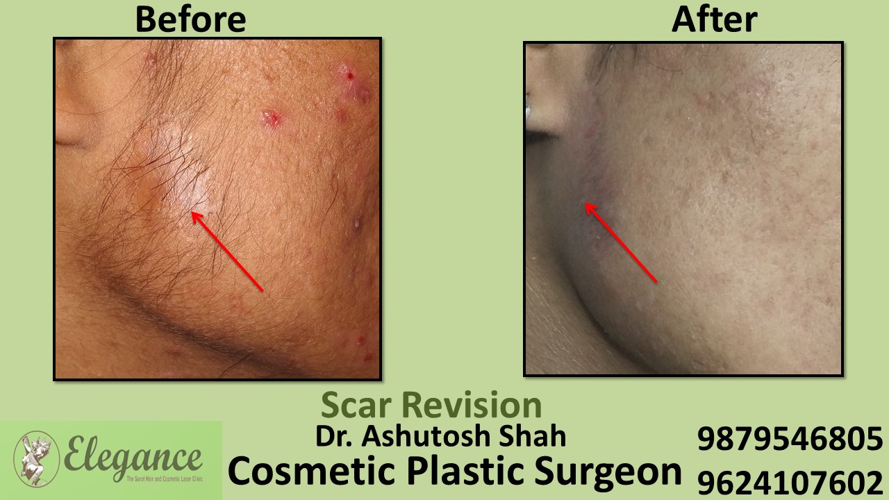 Scar Revision Surgery in Ankleshwar, Gujarat, India