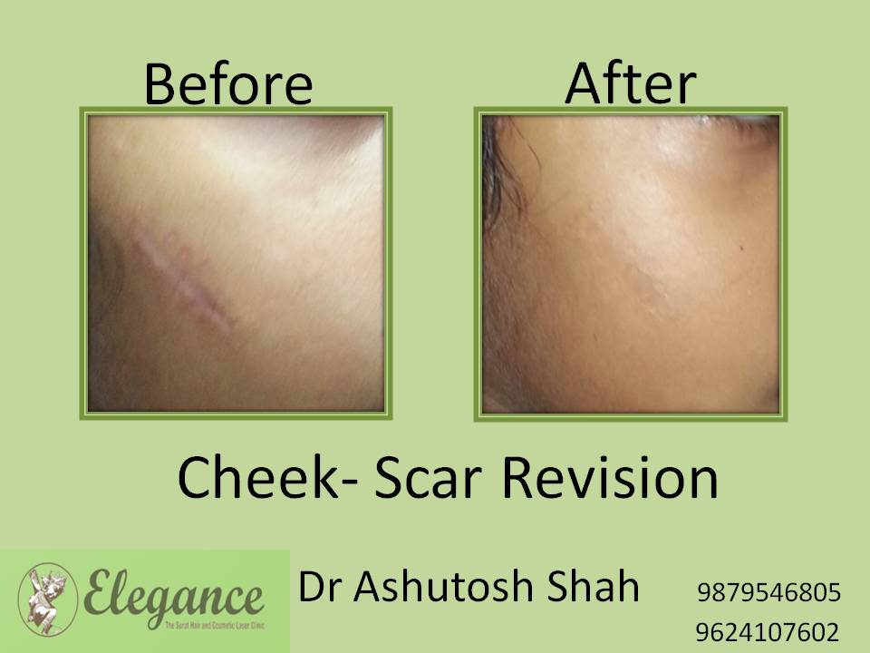 Scar Revision Surgery in BARDOLI, Gujarat