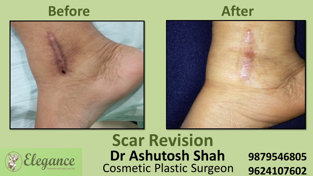 Scar Revision Surgery in Bharuch, Gujarat, India