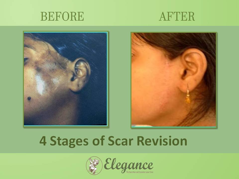 Scar Revision Surgery in Daman, Gujarat, India