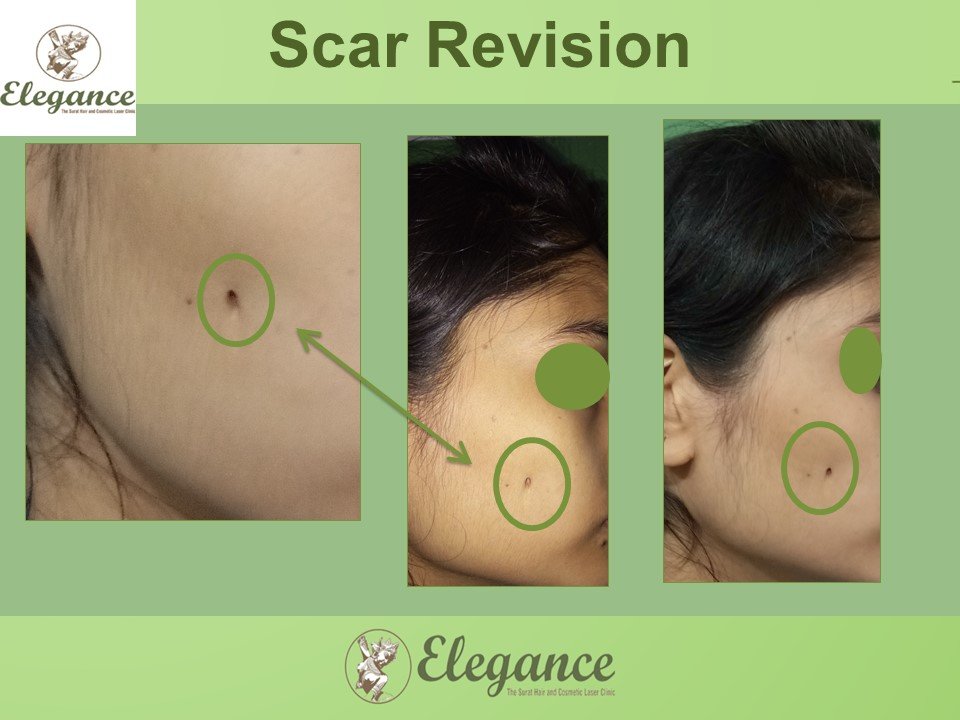 Scar Revision Surgery in Mangrol, Gujarat