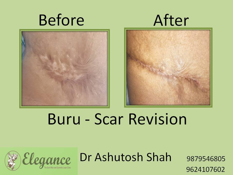 Scar Revision Surgery in Navsari, Gujarat