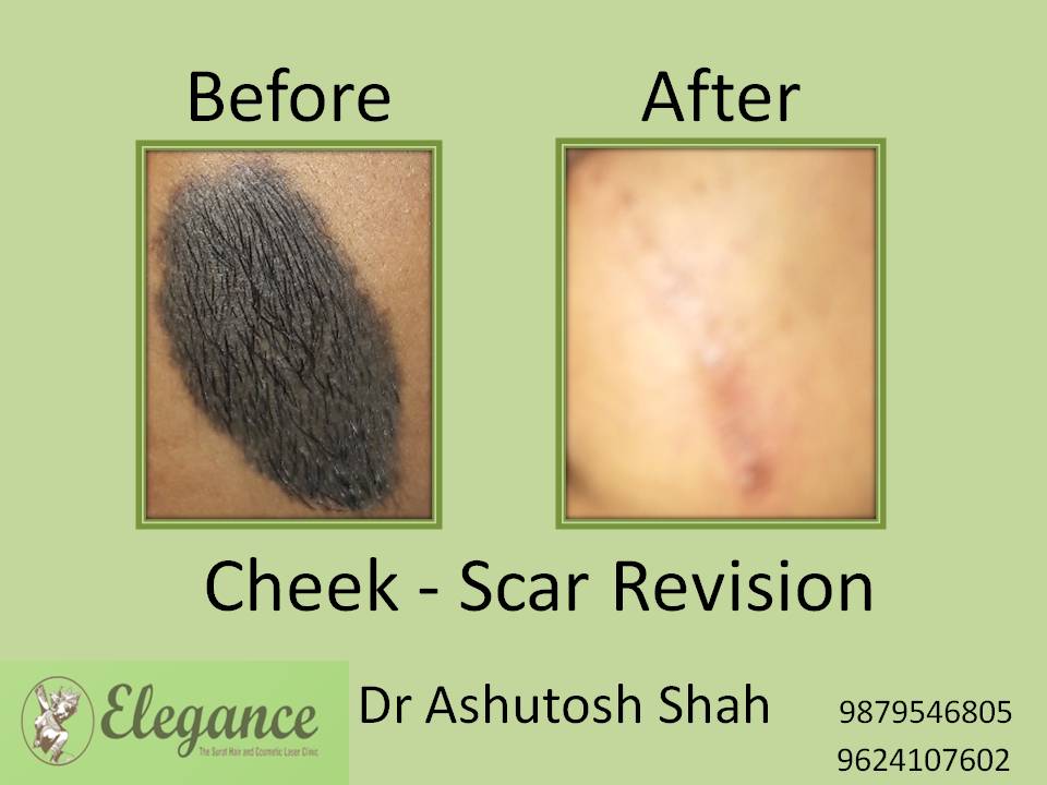Scar Revision Surgery in Surat, Gujarat