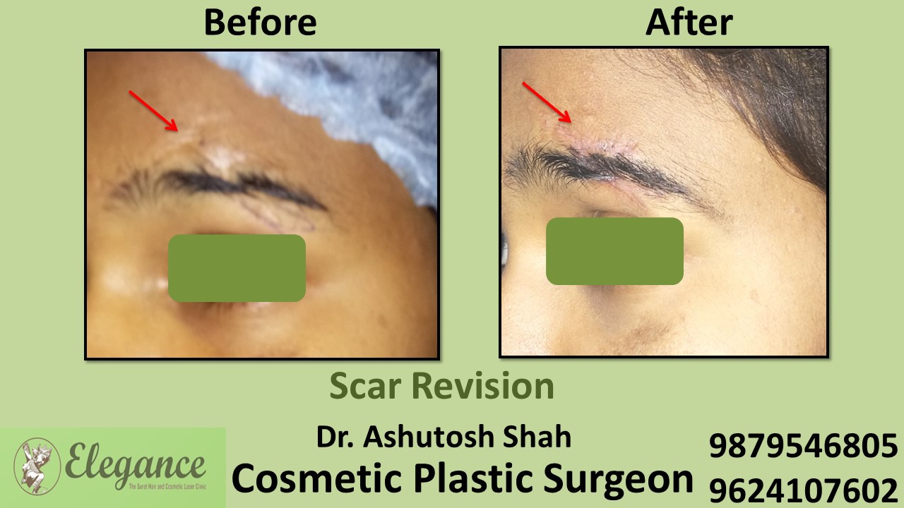 Scar Revision Surgery in Valsad, Gujarat, India