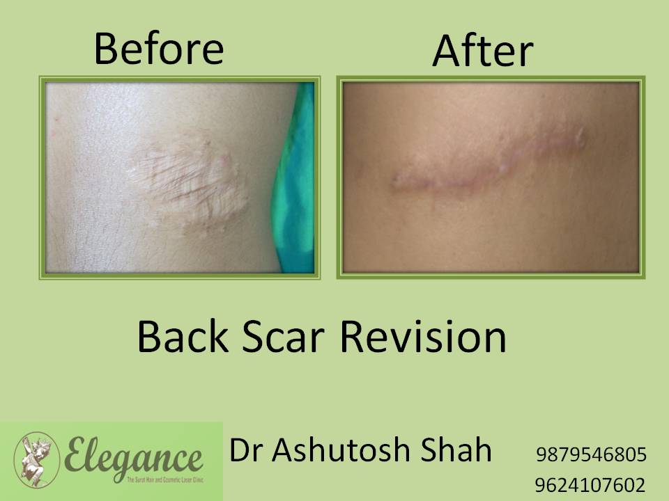 Scar Revision Surgery in Valsad, Gujarat