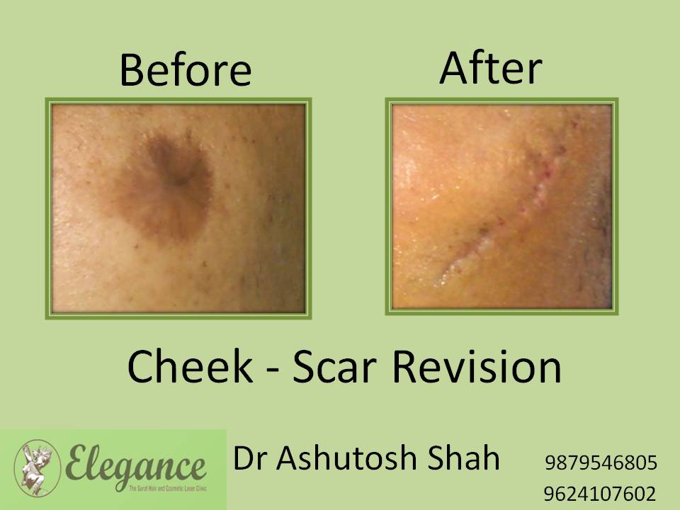 Scar Revision Treatment in Bardoli, Gujarat