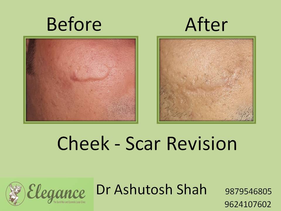 Scar Revision Treatment in Chhota Udaipur, Gujarat