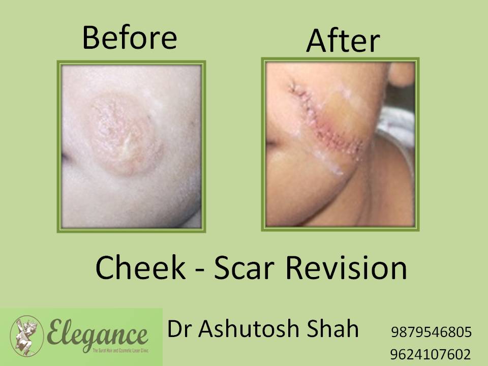 Scar Revision Treatment in Valsad, Gujarat