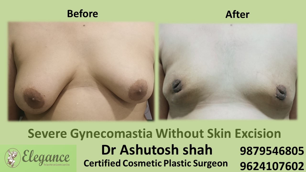 Severe Gynecomastia Surgery, Bharuch, Gujarat