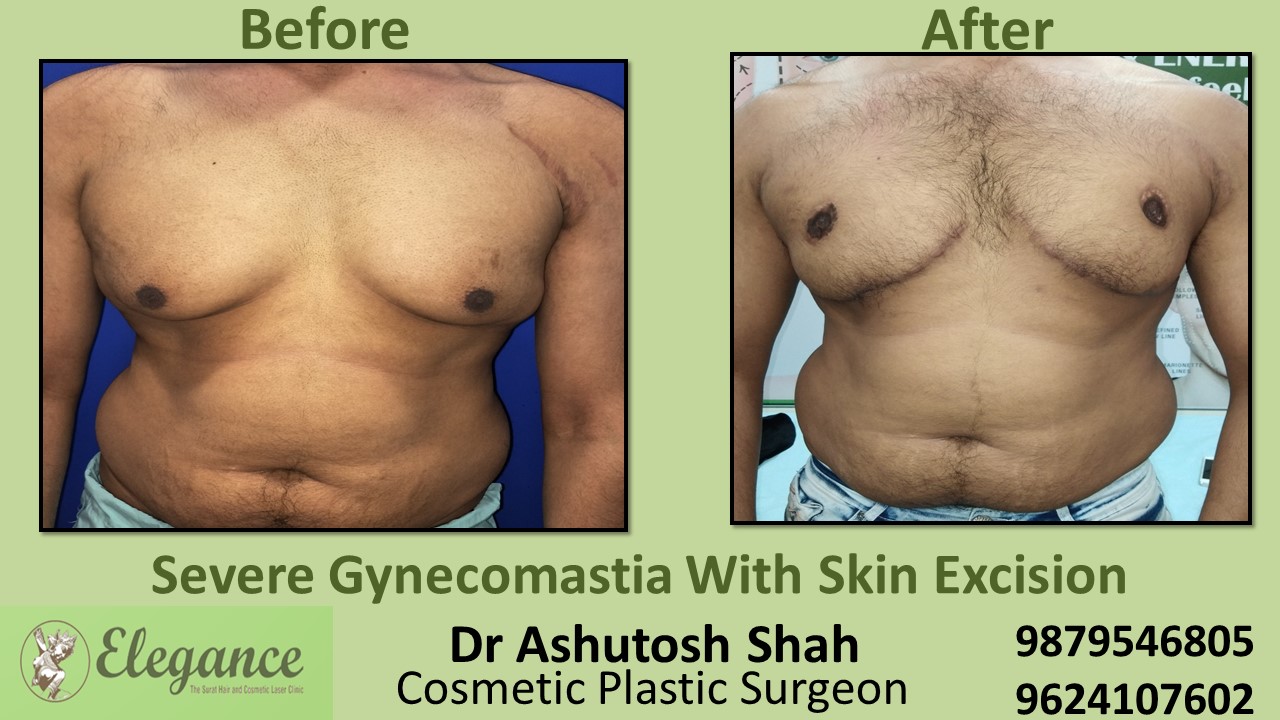 Severe Gynecomastia Surgery, Daman, Gujarat