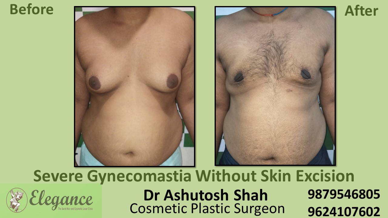 Severe Gynecomastia Surgery, Kim, Gujarat