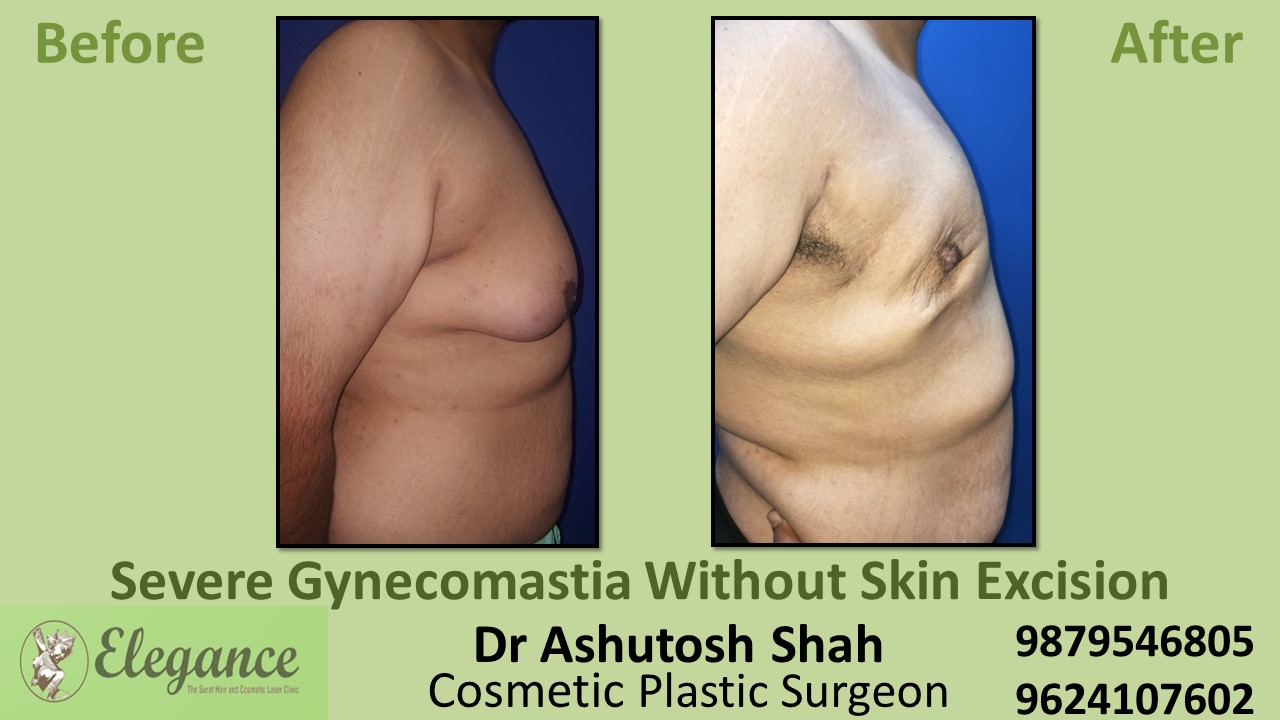 Severe Gynecomastia Surgery, Kosamba, Gujarat
