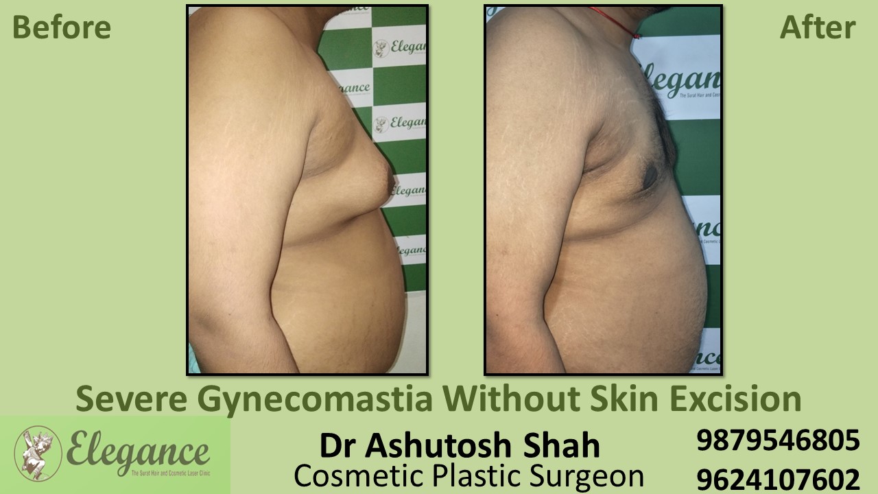 Severe Gynecomastia Surgery, Navsari, Gujarat