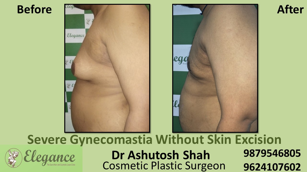 Severe Gynecomastia Surgery, Vadodara, Gujarat