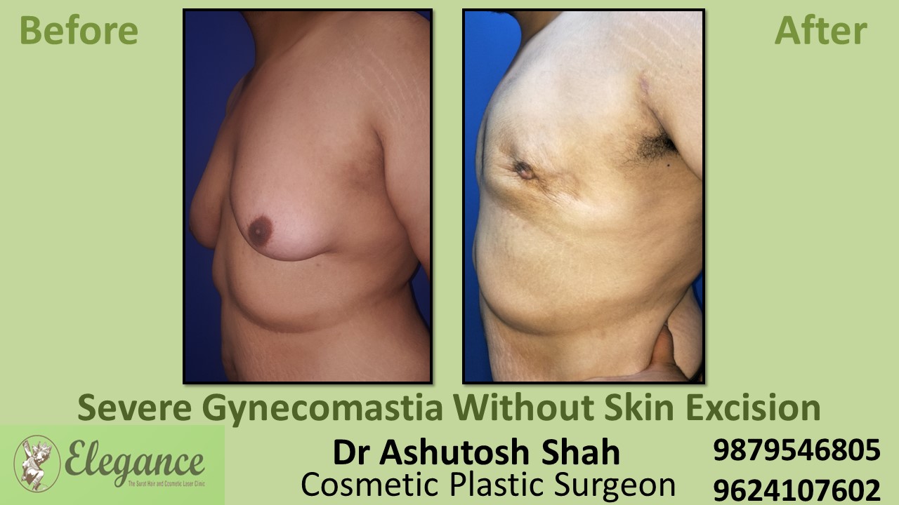 Severe Gynecomastia Surgery, Valsad, Gujarat