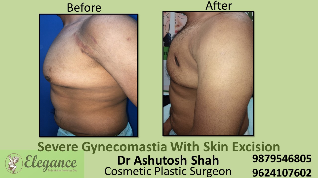 Severe Gynecomastia Surgery, Vapi, Gujarat
