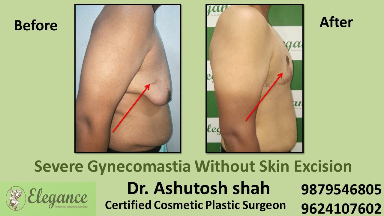 Severe Gynecomastia Treatment, Bardoli, Gujarat