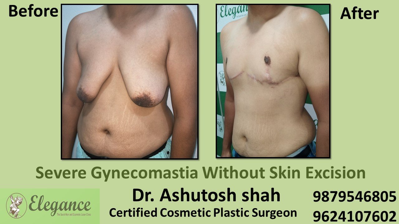 Severe Gynecomastia Treatment, Chhota Udaipur, Gujarat