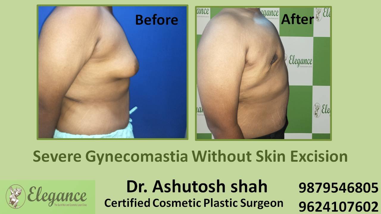 Severe Gynecomastia Treatment, Kamrej, Gujarat