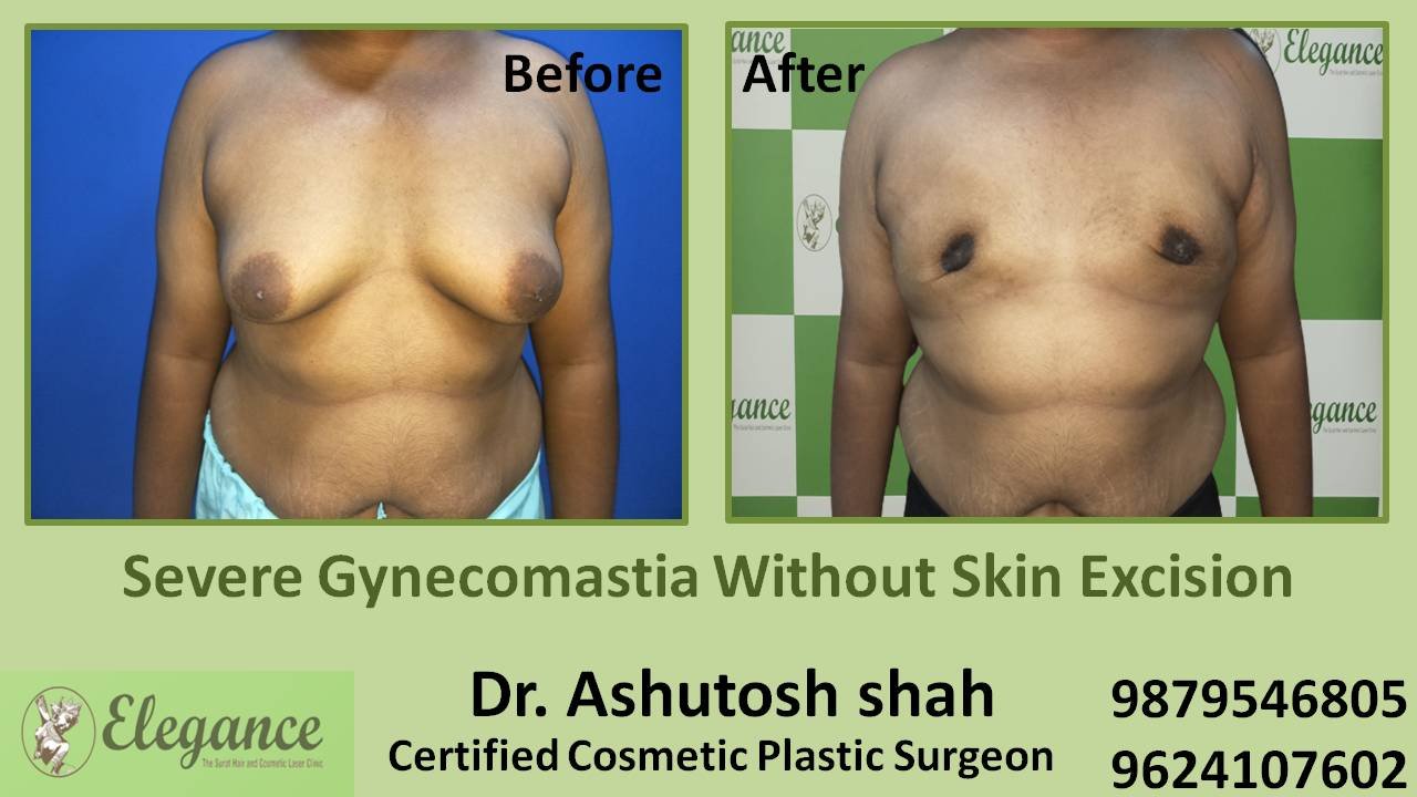 Severe Gynecomastia Treatment, Kim, Gujarat