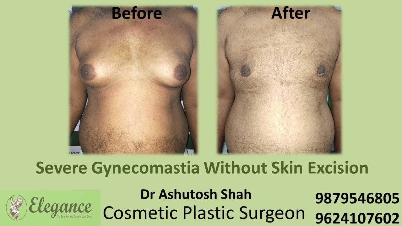 Severe Gynecomastia Treatment, Surat, Gujarat