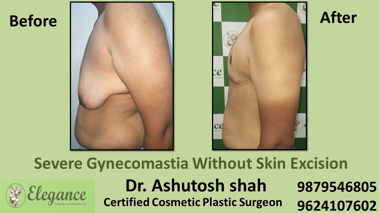 Severe Gynecomastia Treatment, Vapi, Gujarat