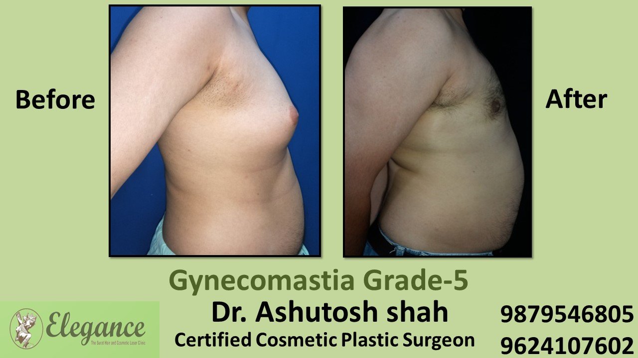 Significant Breast Roll,Gynecomastia Grade-5, Bardoli, Gujarat, India.