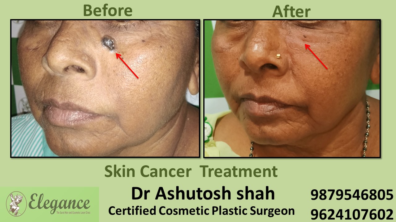 skin-cancer-treatment-in-surat.JPG