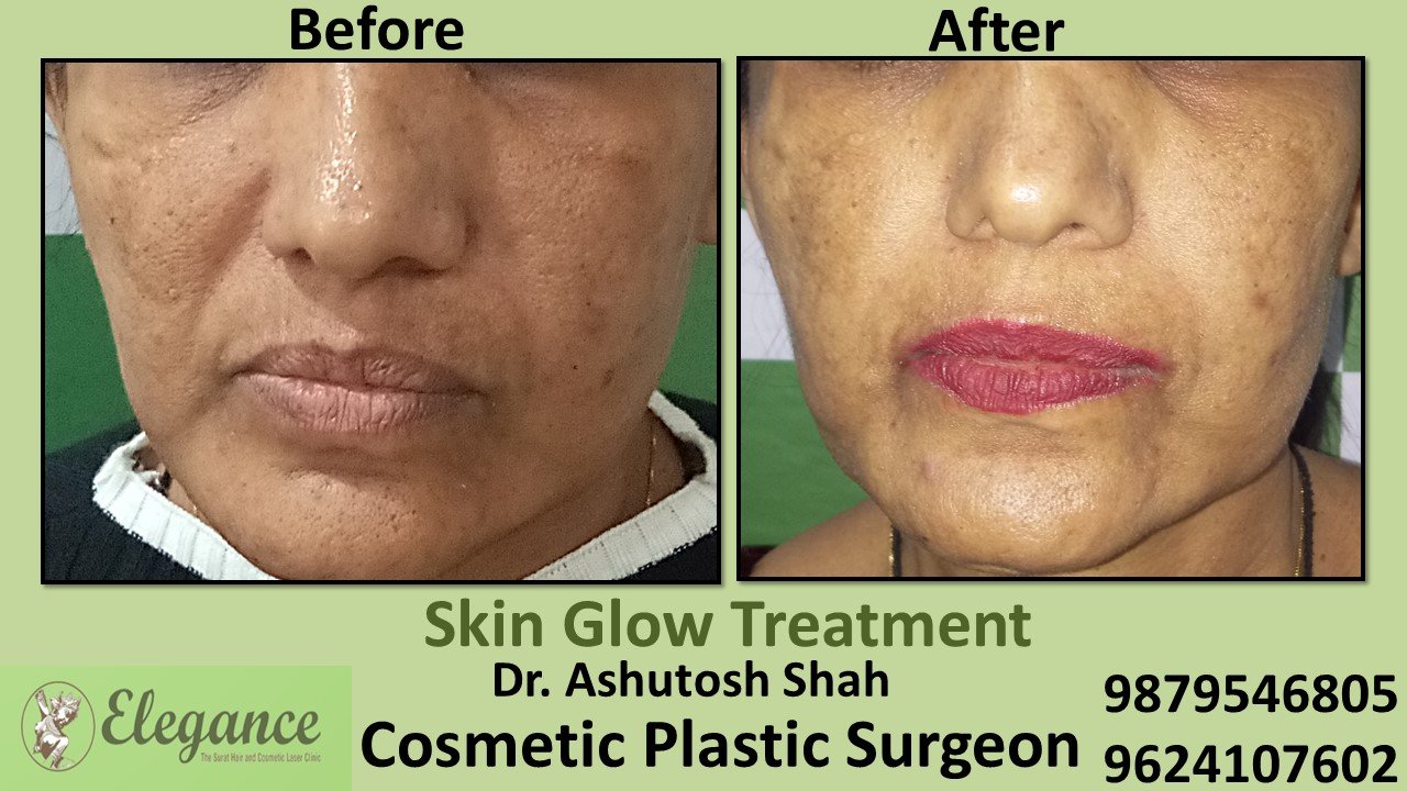 Skin Glow Treatment in Mumbai, Maharashtra