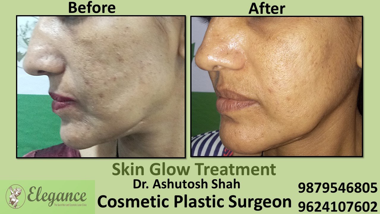 Skin Glow Treatment in Surat, Gujarat