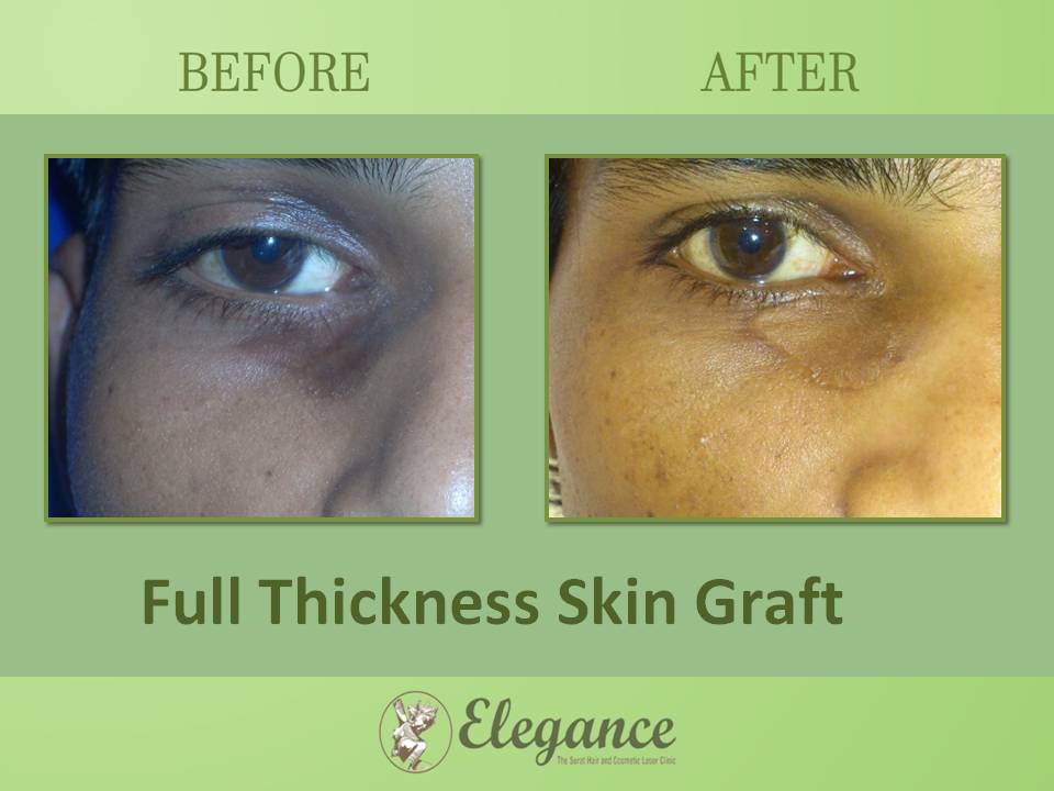 Skin Grafting Surgery, Bharuch, Gujarat, India