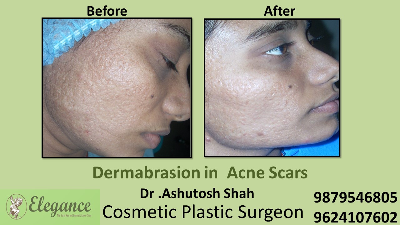 Face pimple | Scar treatment, Marks treatment in Vesu, Katargam, Surat