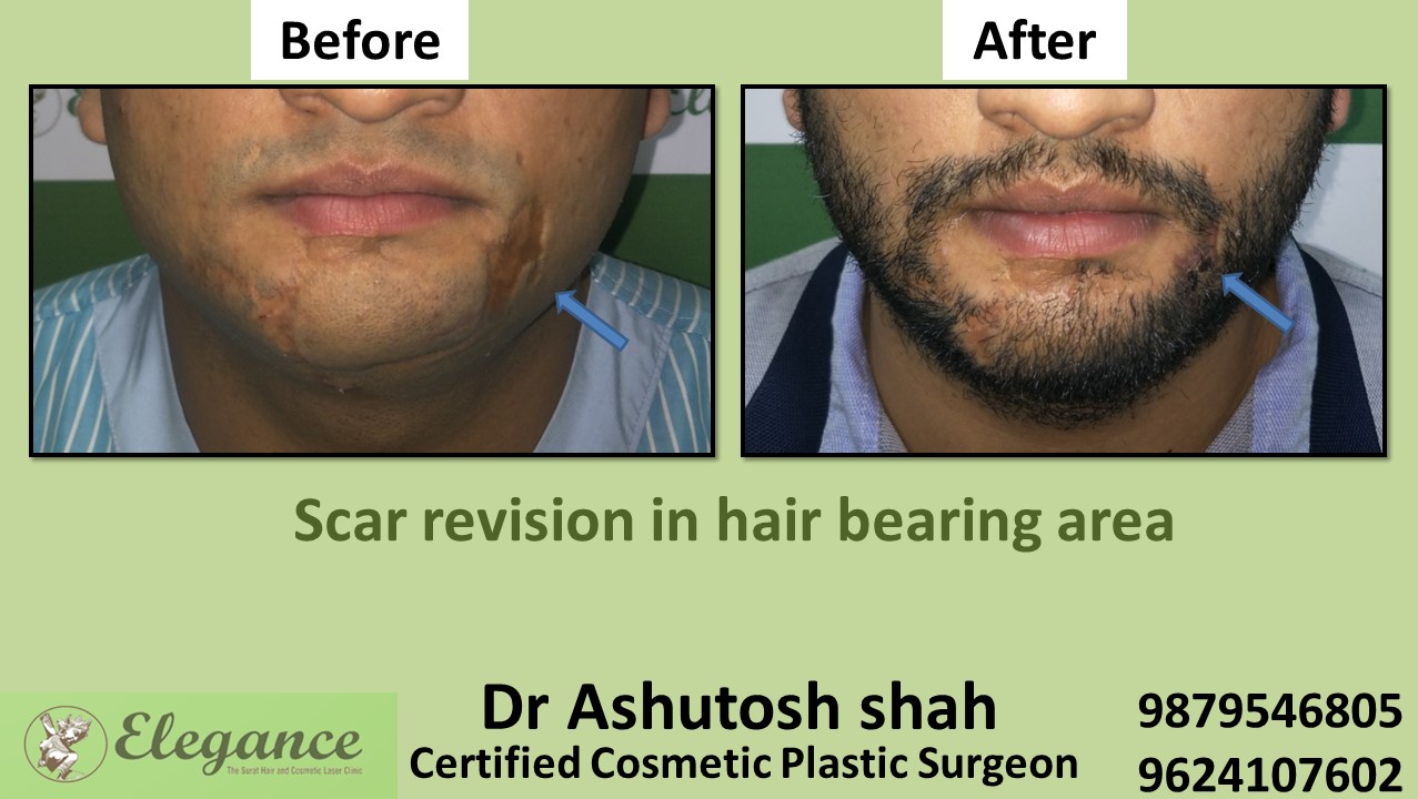 Scar removal , Scar revision in Kim, Valsad, Surat