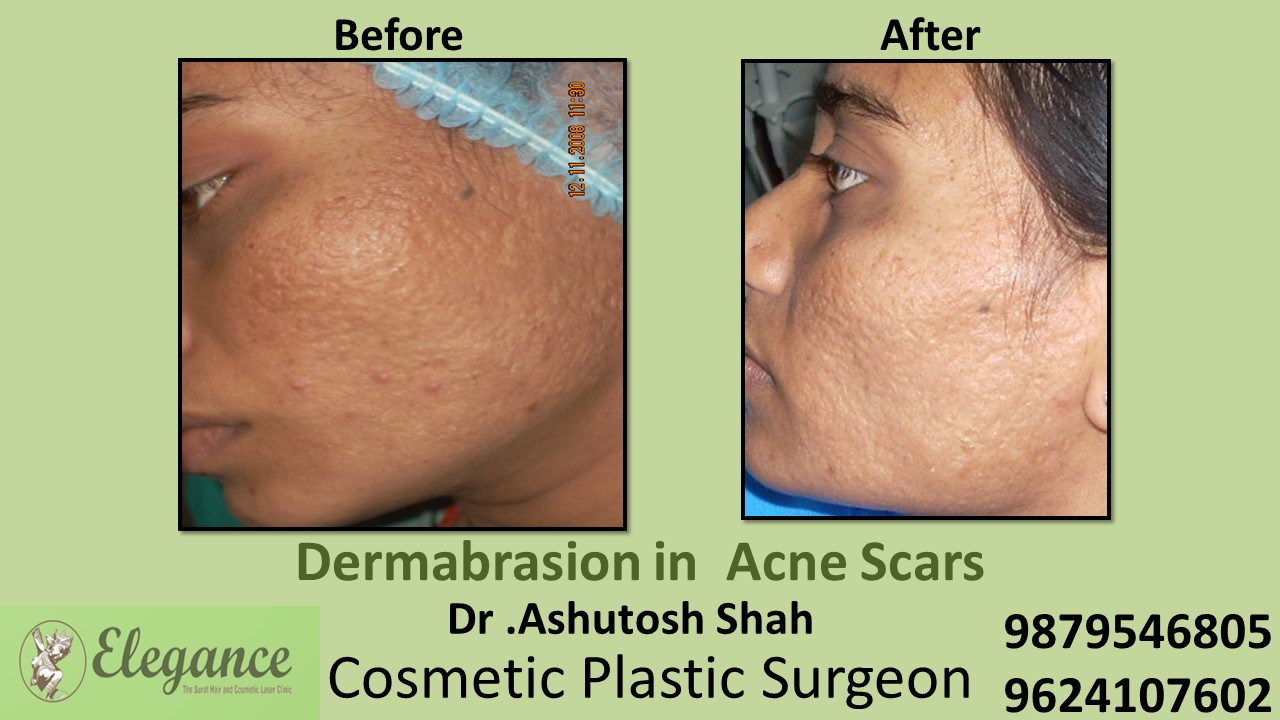 Face acne treatment, scar Treatment in Varchha, Magdalla, Dumas, Surat