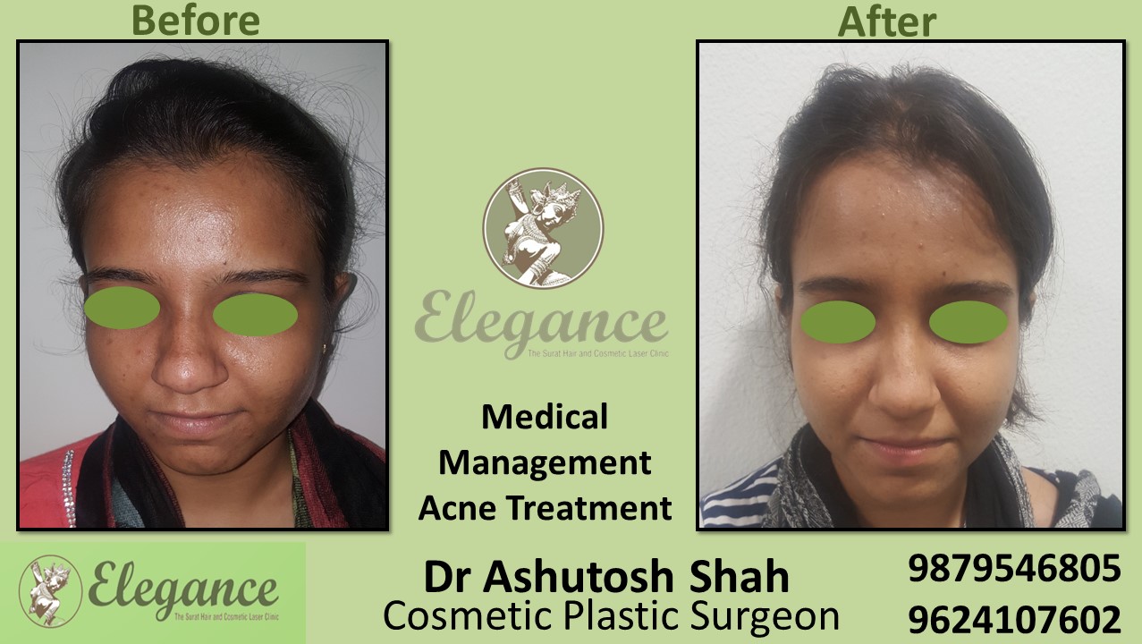 Acne scars reduction treatment in Vapi, Bharuch, Surat