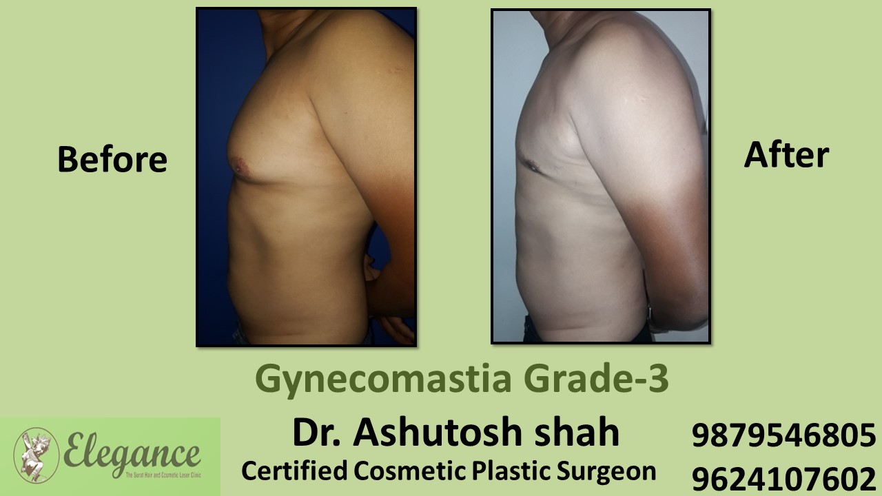 Slight Breast Roll, Gynecomastia Grade-3, Bardoli, Gujarat, India.