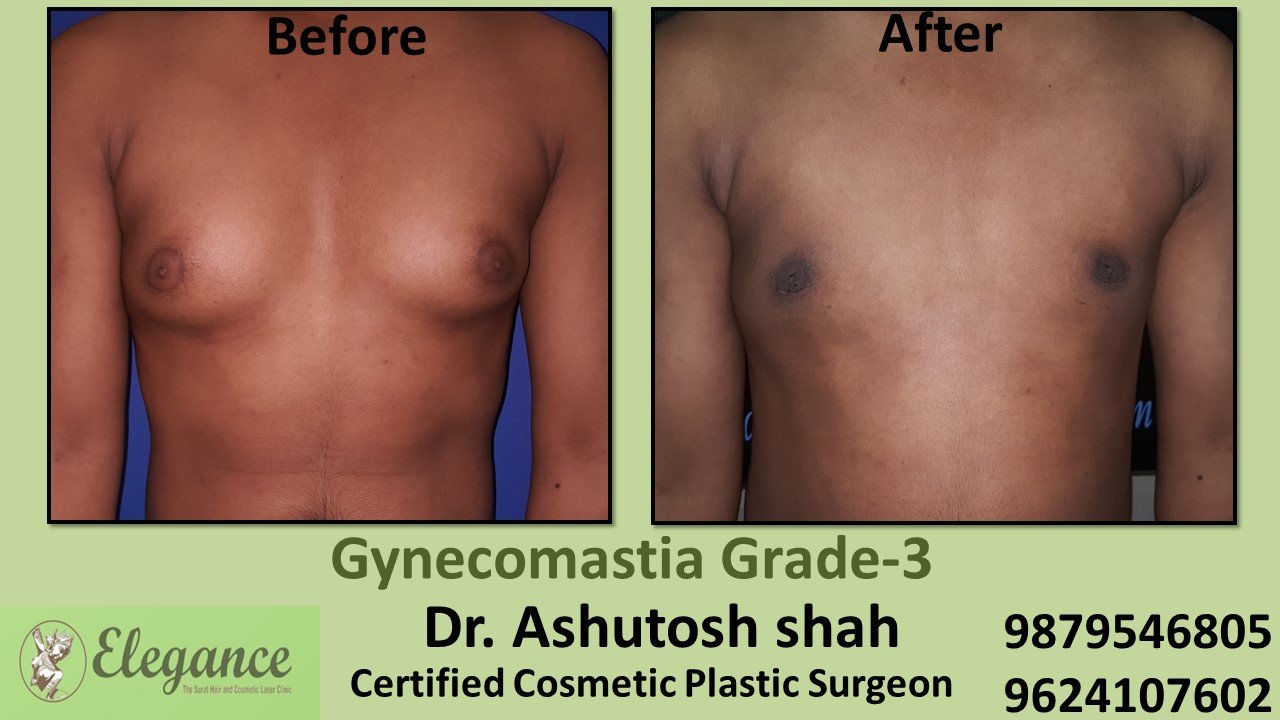 Slight Breast Roll, Gynecomastia Grade-3, Bilimora, Gujarat, India.